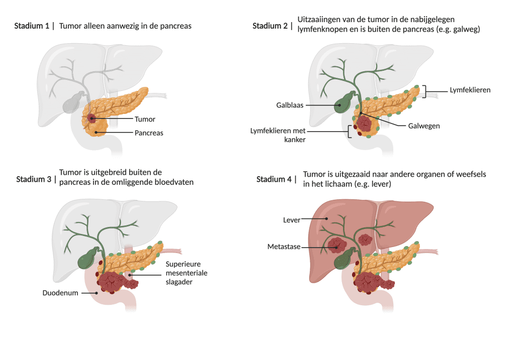 Pancreaskanker Symptomen Diagnose En Stadia Elmedix