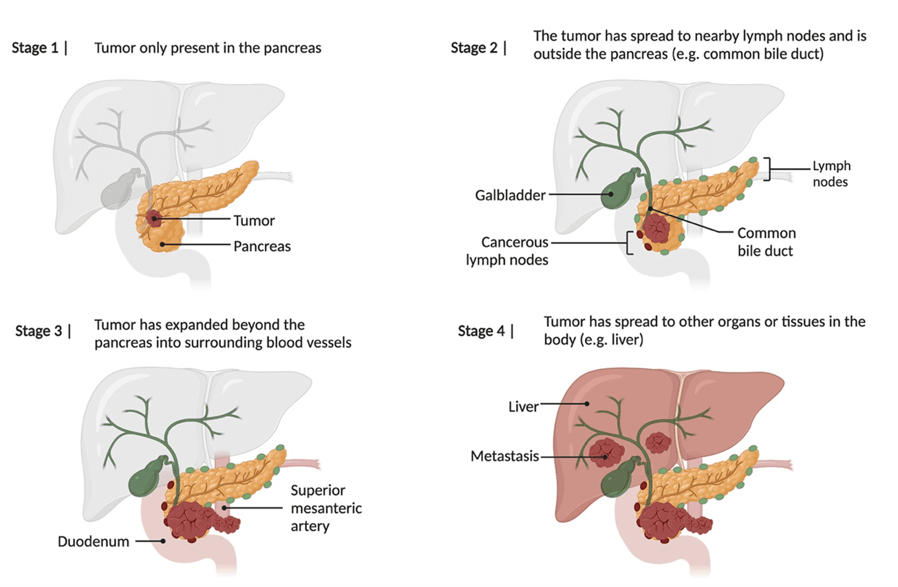 Pancreatic cancer symptoms diagnosis and stages elmedix